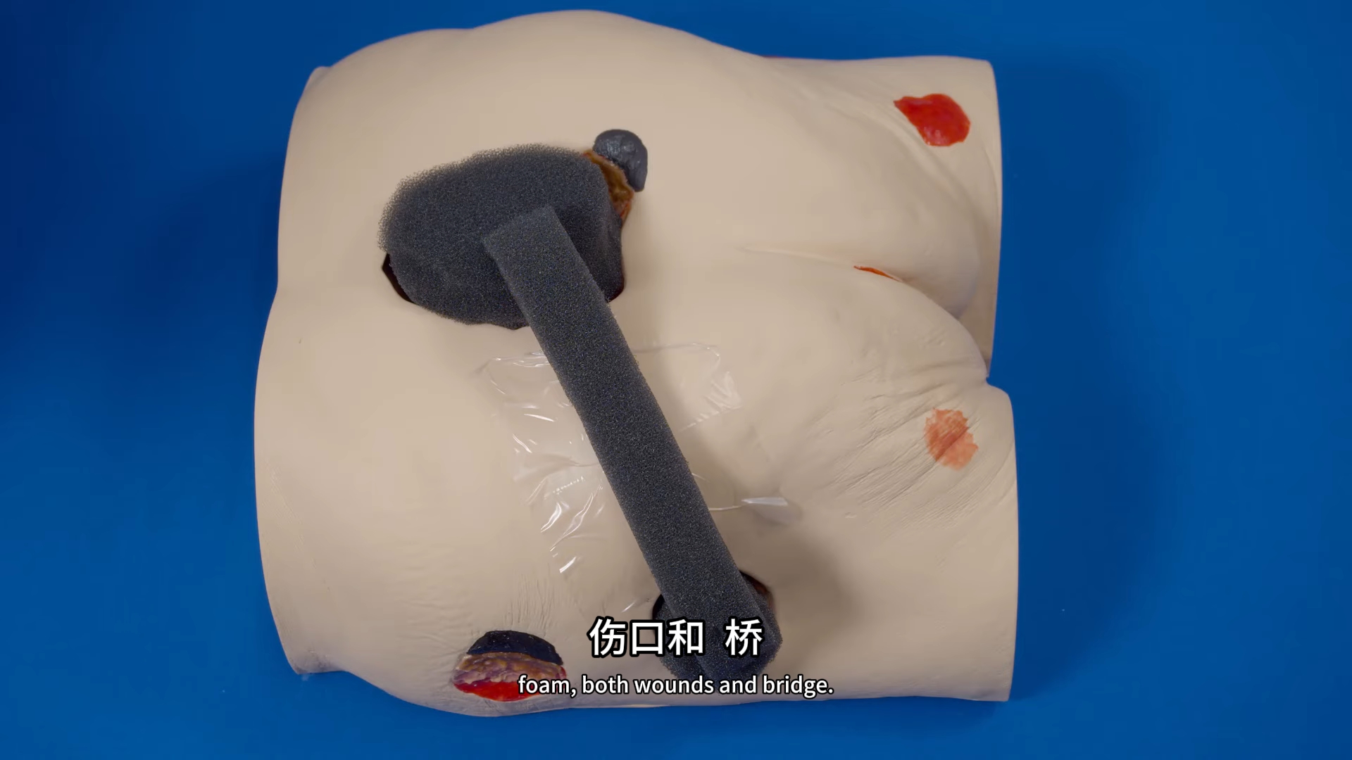 负压引流两个伤口的搭桥方法